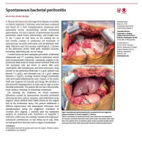 Spontaneous bacterial peritonitis