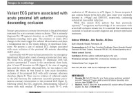 Variant ECG pattern associated with acute proximal left anterior descending occlusion