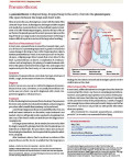 Pneumothorax